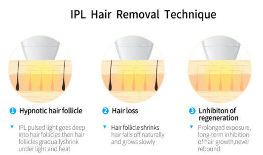 2000w OPT IPL+ 808NM DIODE LASER technology สำหรับอุปกรณ์กำจัดขน