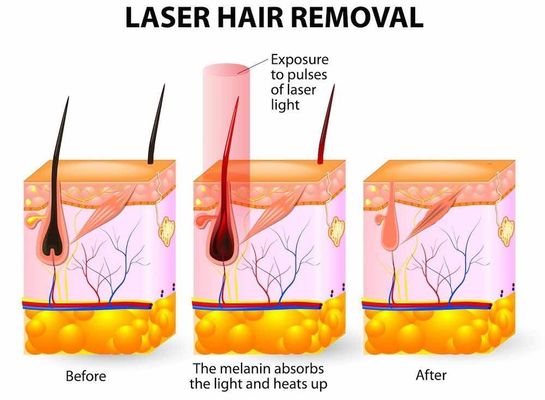 OPT IPL / OPT เครื่องมัลติฟังก์ชั่นแบบพกพา IPL Fast Hair Removal