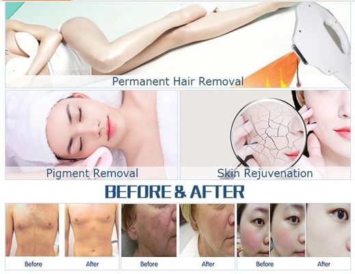 OPT IPL / OPT เครื่องมัลติฟังก์ชั่นแบบพกพา IPL Fast Hair Removal